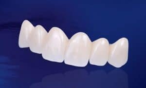 Phục hình Zirconia